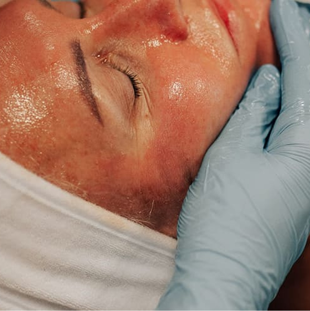Couperose treatment: ošetření pro pleť s kuperózou